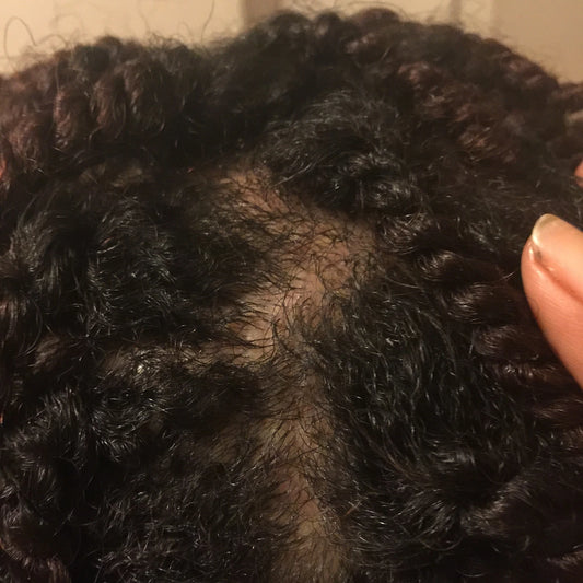 Scalp Health: Central Centrifugal Cicatricial Alopecia